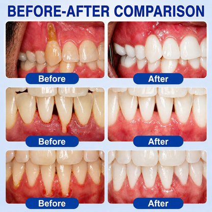 👨‍⚕️✅🦷 HISKIN® GumRevive Periodontal Repair Gel
