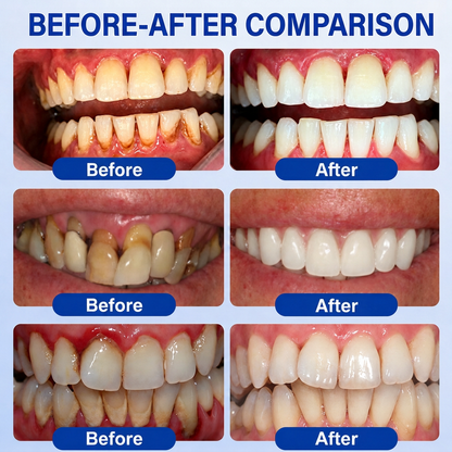 👨‍⚕️✅🦷 HISKIN® GumRevive Periodontal Repair Gel