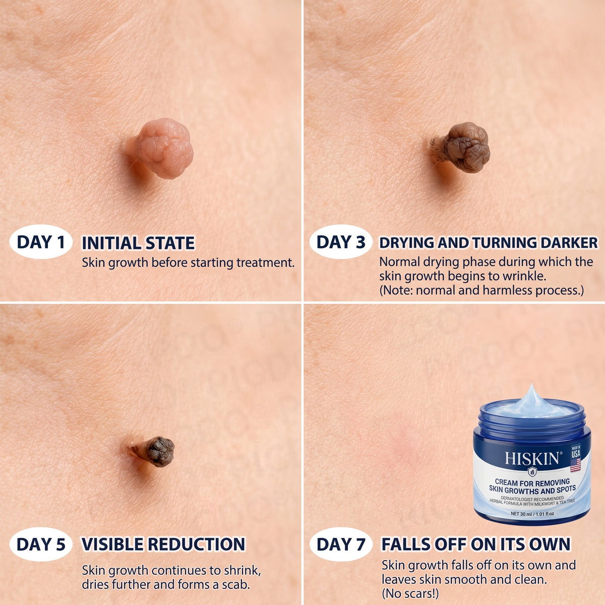 HISKIN® 10-in-1 Targeted Skin Tag & Dark Spot Cream – 7-Day Painless, Scar-Free Herbal Formula